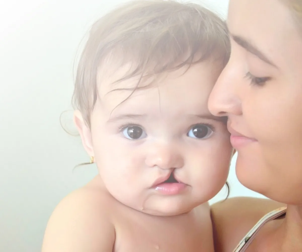 Una madre besa a su bebé, que tiene fisura labial