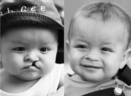 El mismo bebé antes y después de la operación de labio