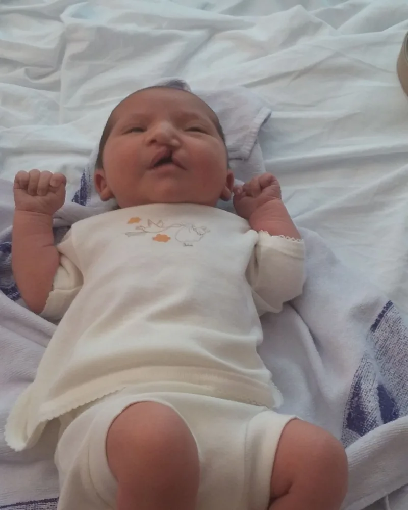 Nuestra hija recién nacida, en 2015, con fisura labial