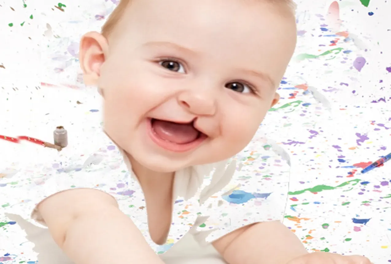 Un bebé con fisura labial, sonriendo